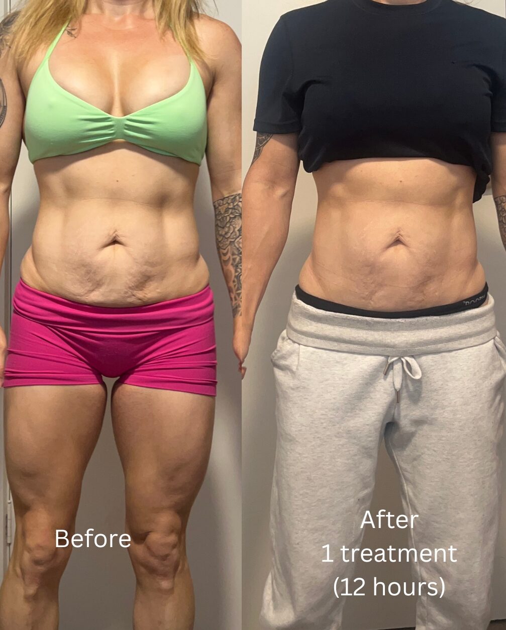 RF Skin Tightening Results