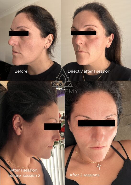 RF Skin Tightening